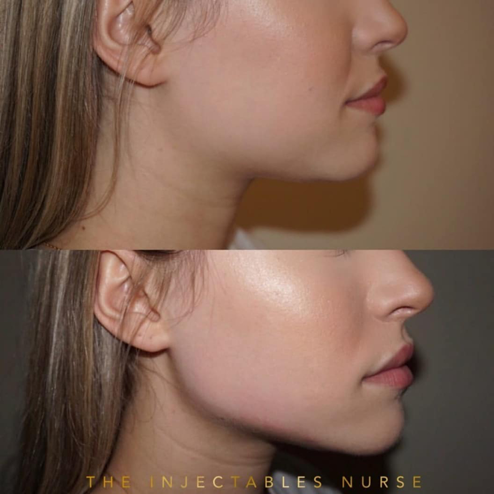 Jawline Filler