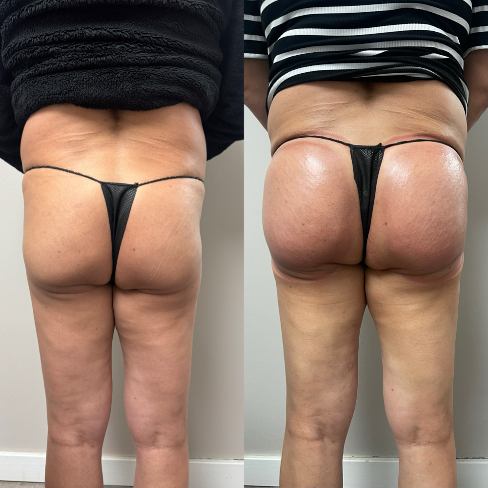 Vacuum ButtLift at Corin’s Skin in Inverness, IL