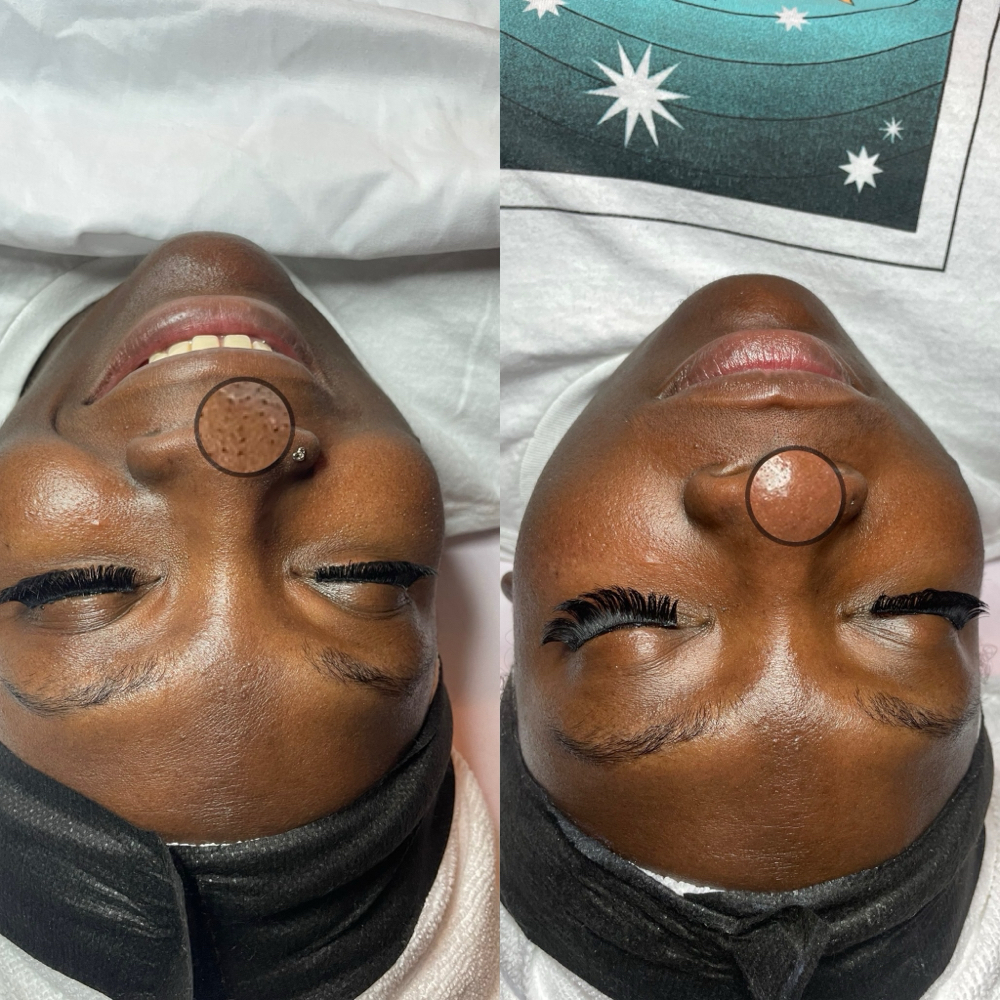 HYDRAFACIAL