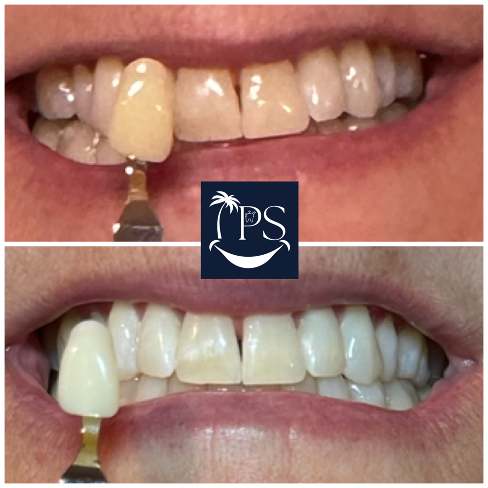 ULTIMATE WHITENING at Island Pro Smiles Mobile Teeth Whitening in Sandwich, MA