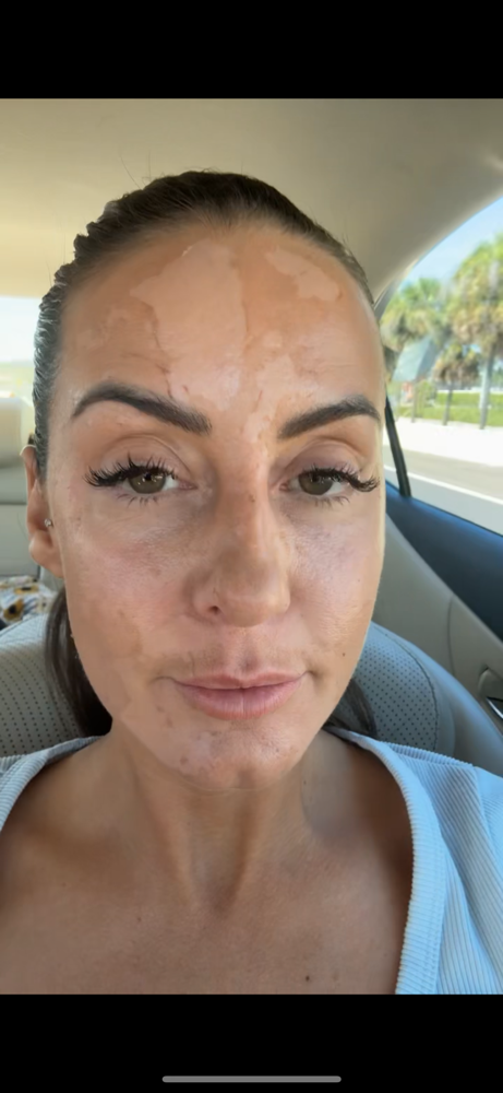 Mobile Chemical Peel