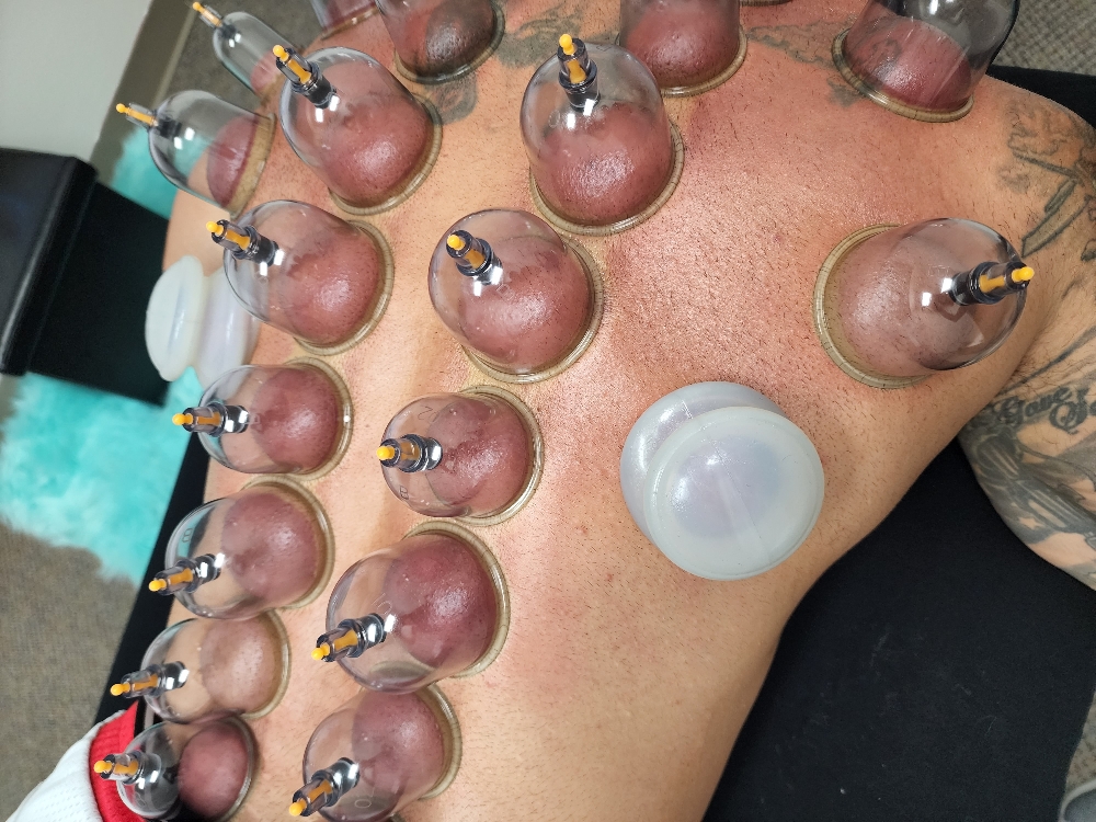 Cupping Therapy