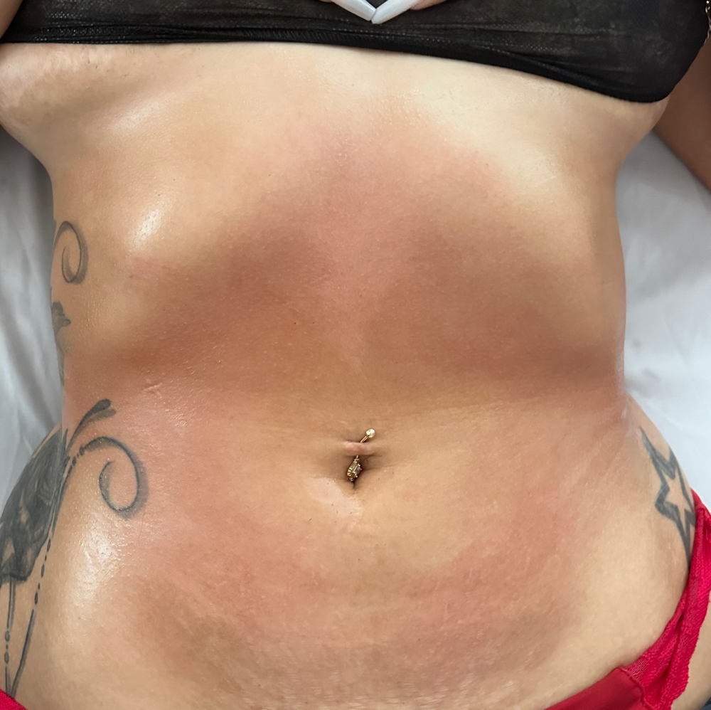 5 Abd,Waist,Back Maderotherapy