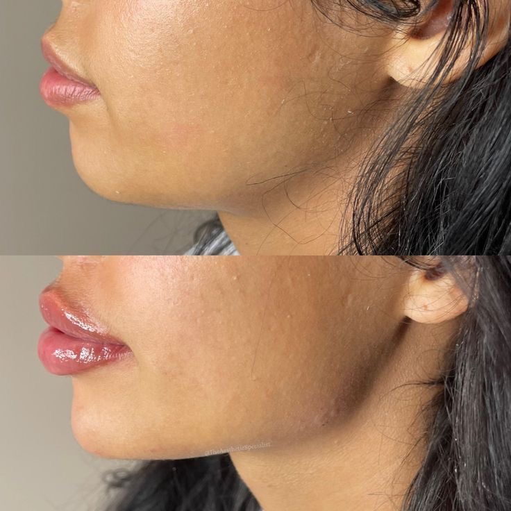 Marcación Mandibular Con NANO SOFT at Sashy Beauty Studio in Carolina, PR
