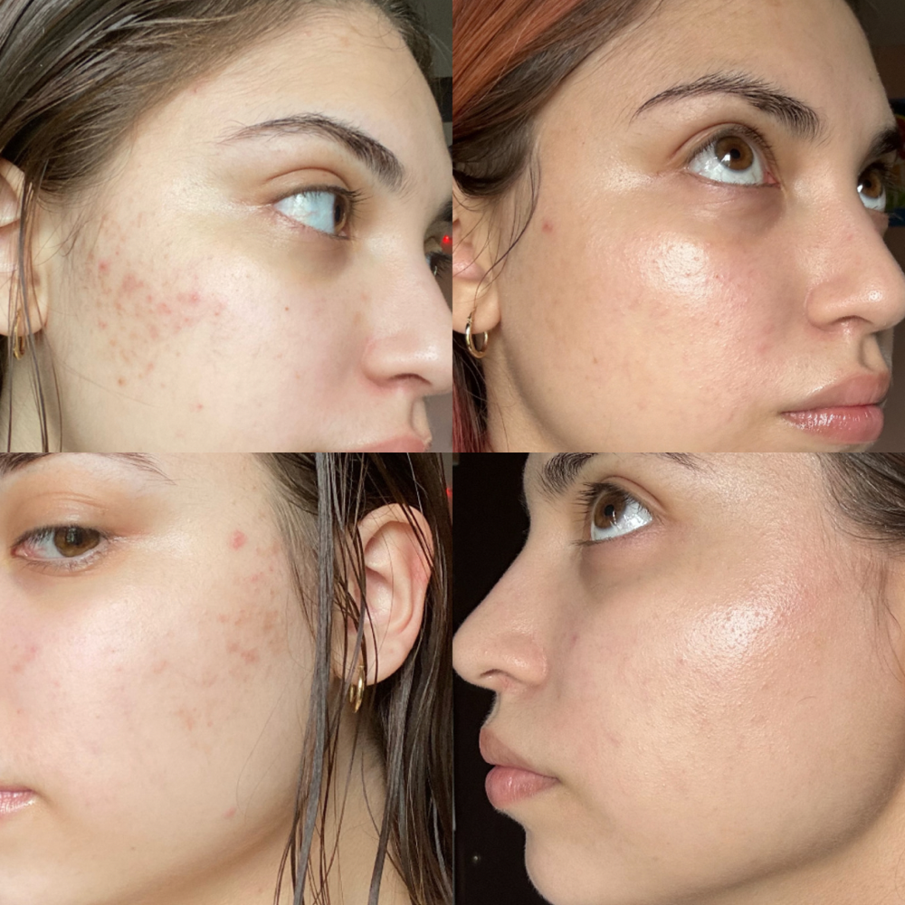 Biweekly Acne Management