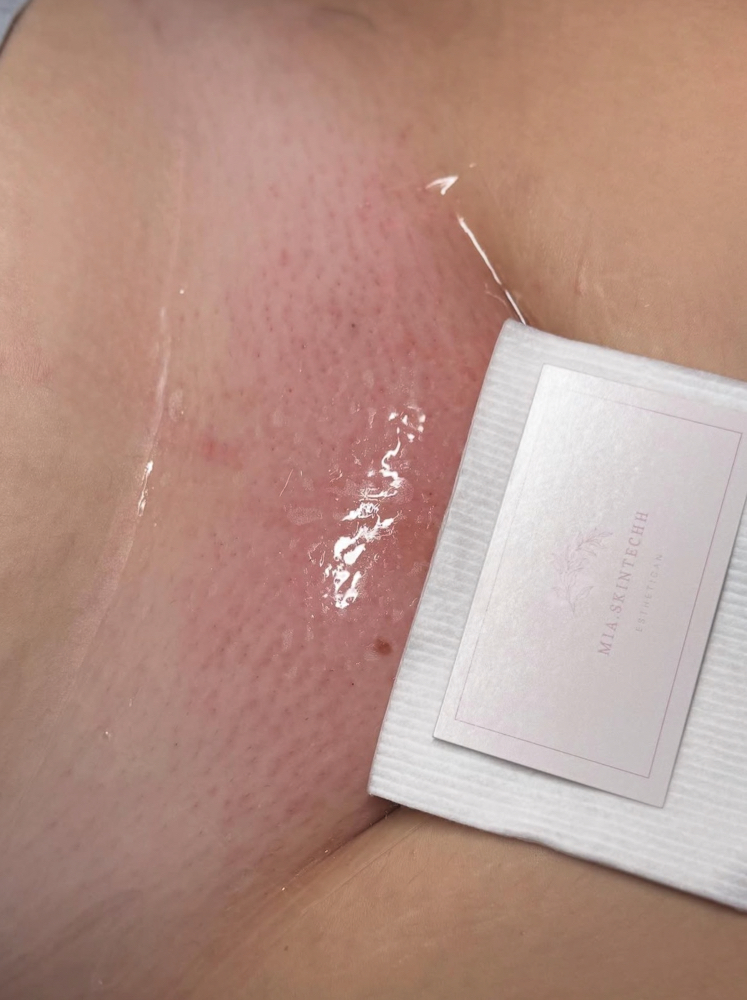 Vaginal Mask + Brazilian