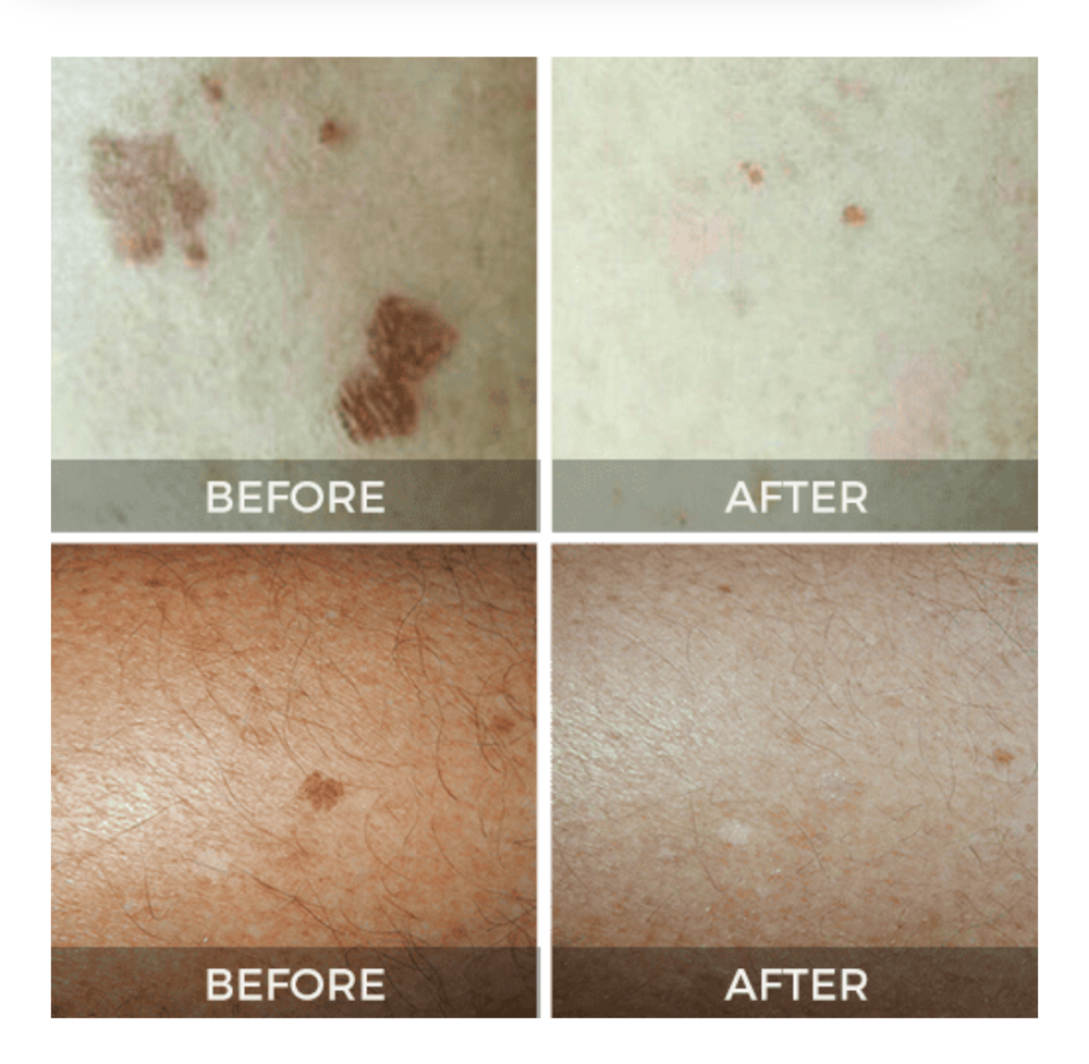 CryoClear