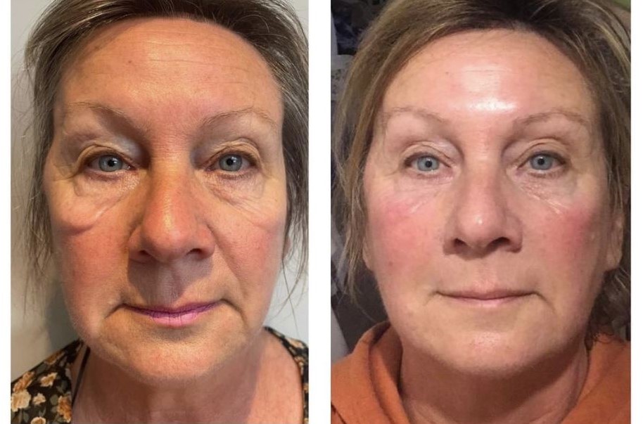 Anti-Aging Facial