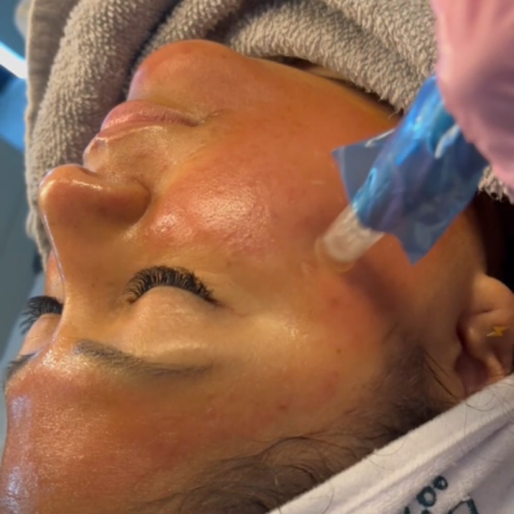 Microneedling+Chemical Peel+PDRN at KC SKIN GLOW in Salt Lake City, UT