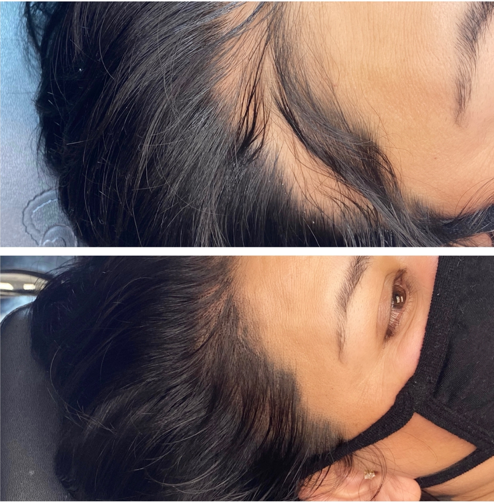 Scalp Micro Pigmentation Consult