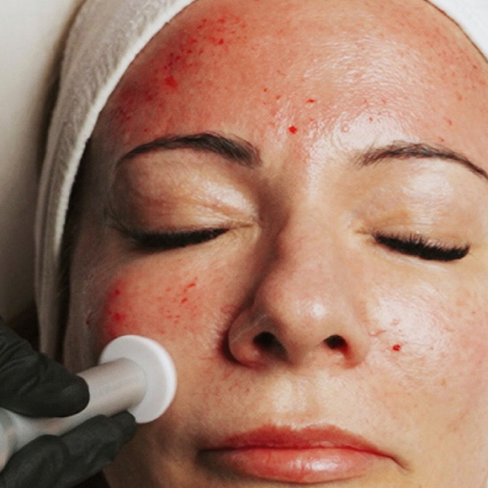 Procell Skin Rejuvenation at Golden Hour Skin Studio in Sarasota, FL