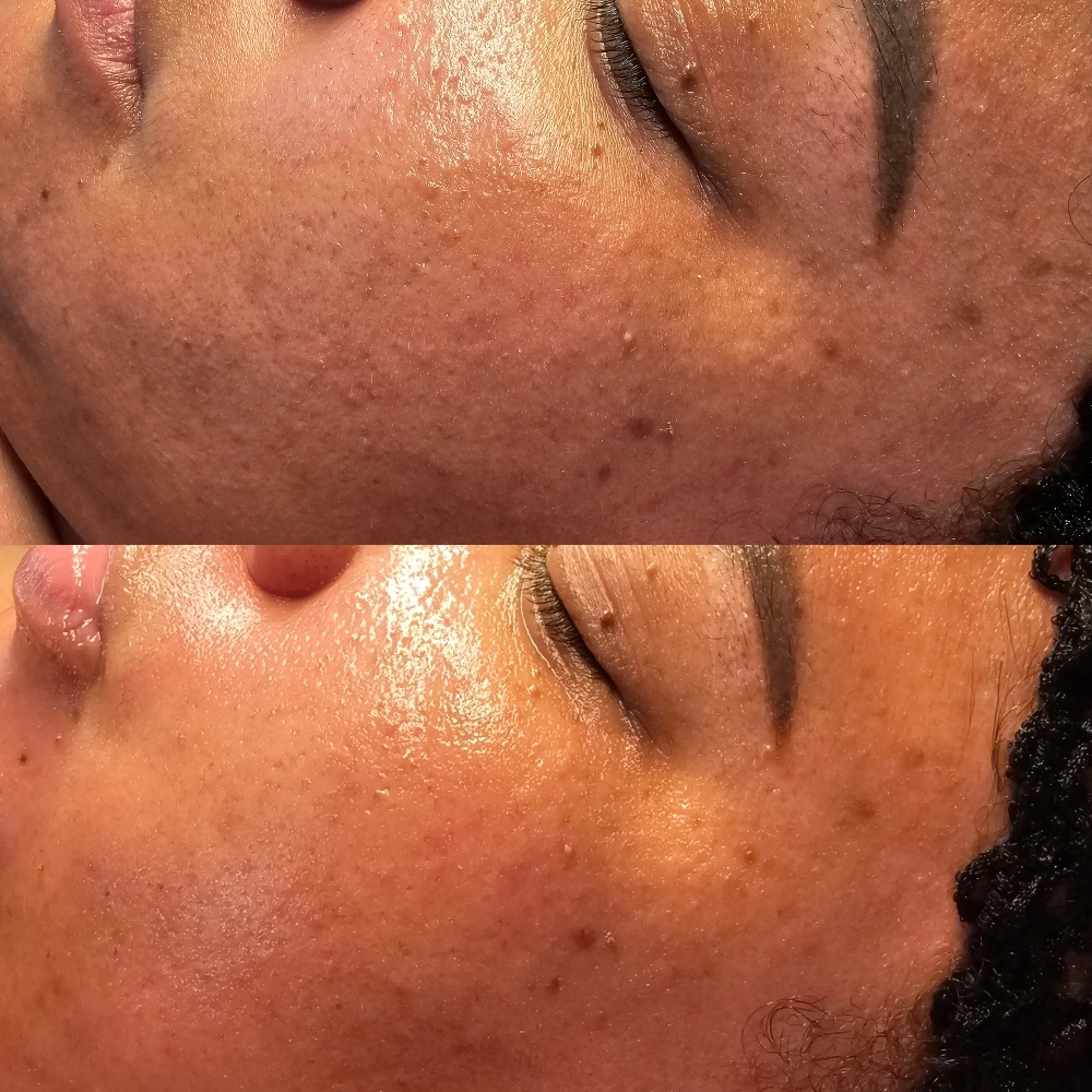 The Peel Facial at Aligned Beauty & Wellness in Davenport, IA