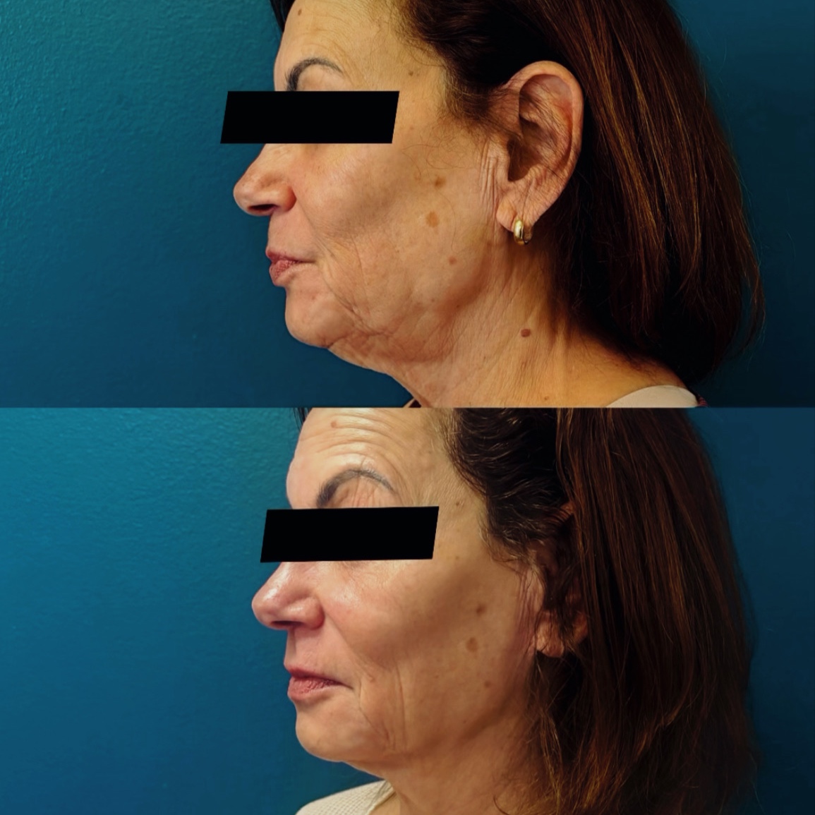 BareFruit Lift & Sculpt Facial at BareFruit Body Lab in Alexandria, VA