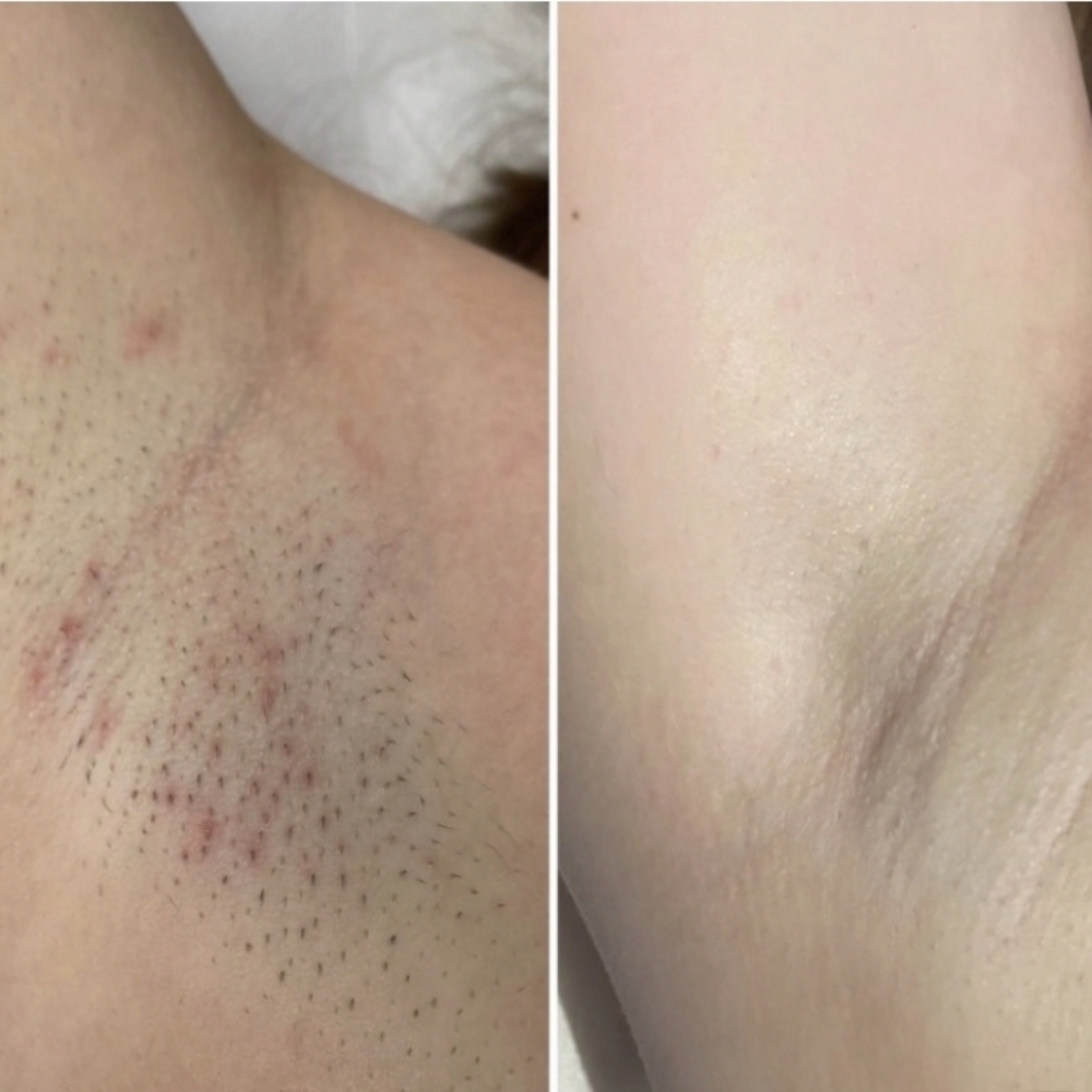 Underarms Laser Hair Removal at Celtic Spa Laser Services in Attleboro, MA