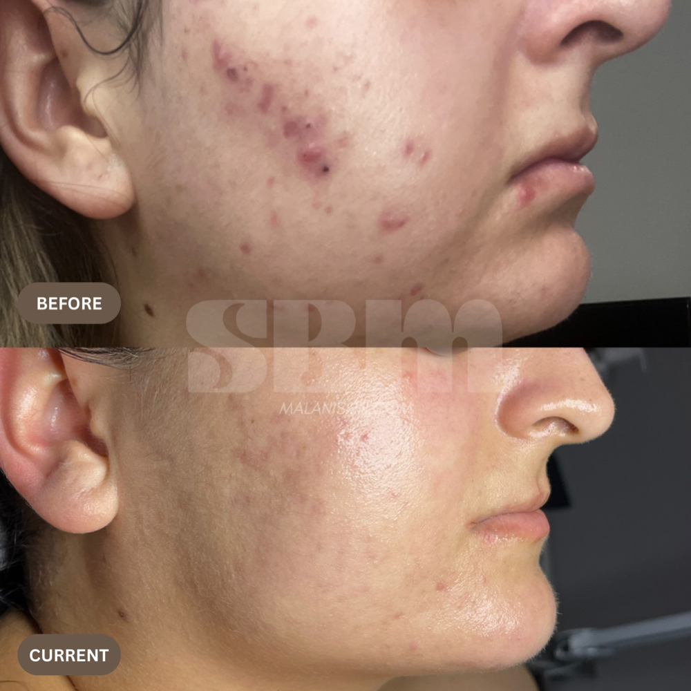 Corrective Custom Facial