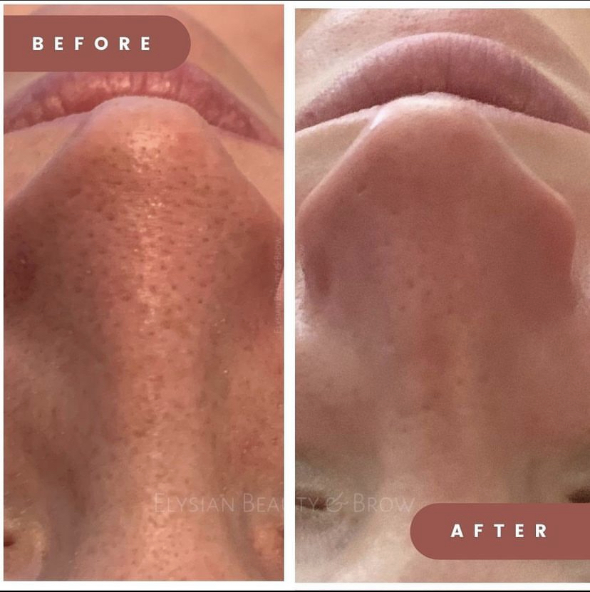 FaceReality Acne with Hydro Facial