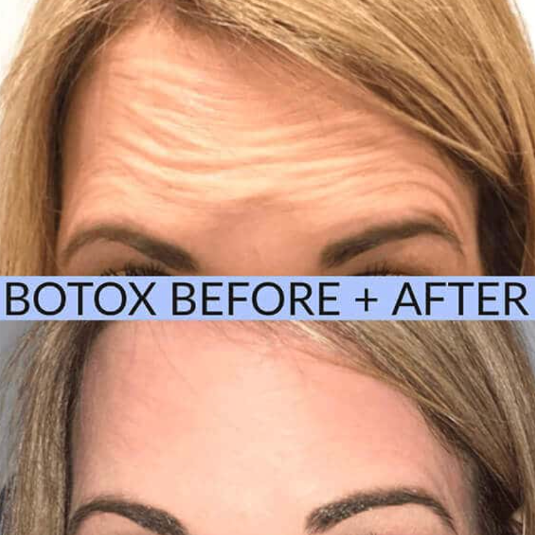 Botox at Knight Aesthetics in Lawton, OK