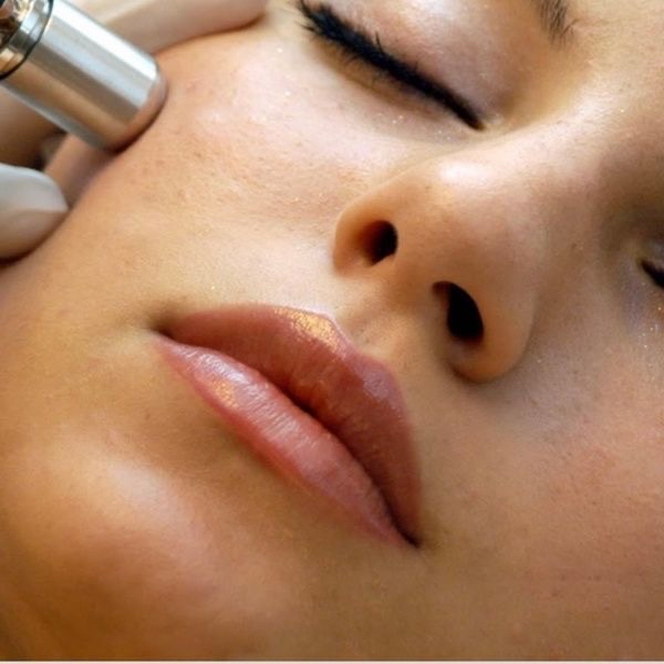 Microdermabrasion