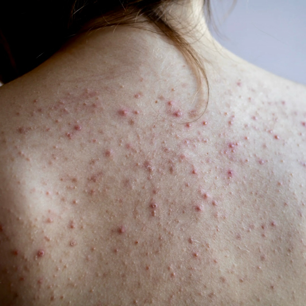 Acne Laser Treatment