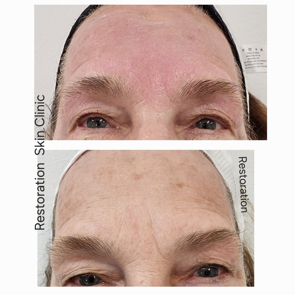 Plasma PEN Fibroblast SKIN BROWLIFT