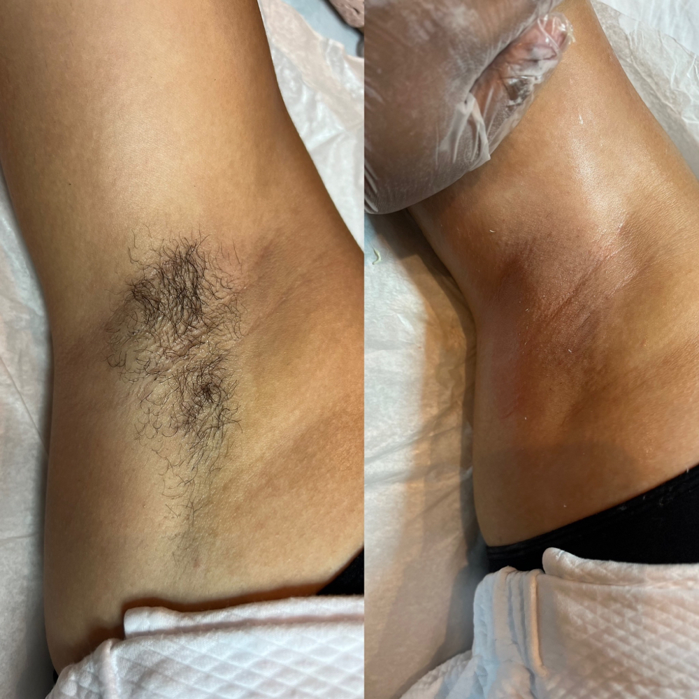Underarm Wax