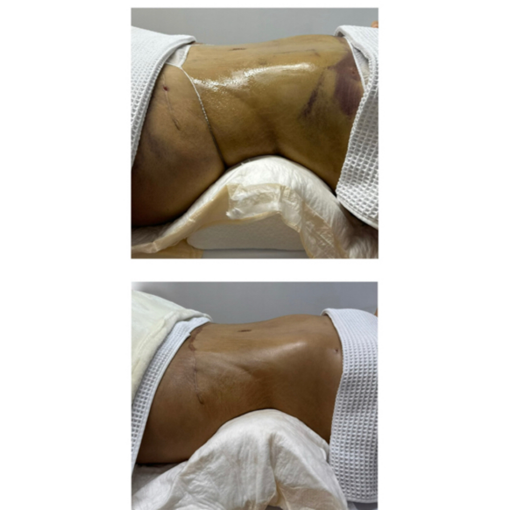 POST OP. MLD at Luxe Beauty Studio in Cottonwood, AZ