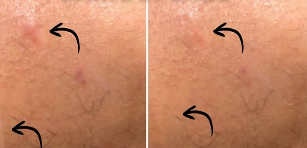 Scar Lightening Only