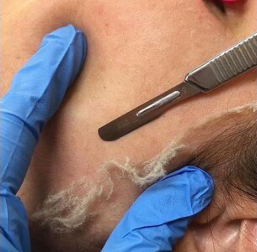 Dermaplaning Facial at Ultimate Skin Care in Flanders, NJ
