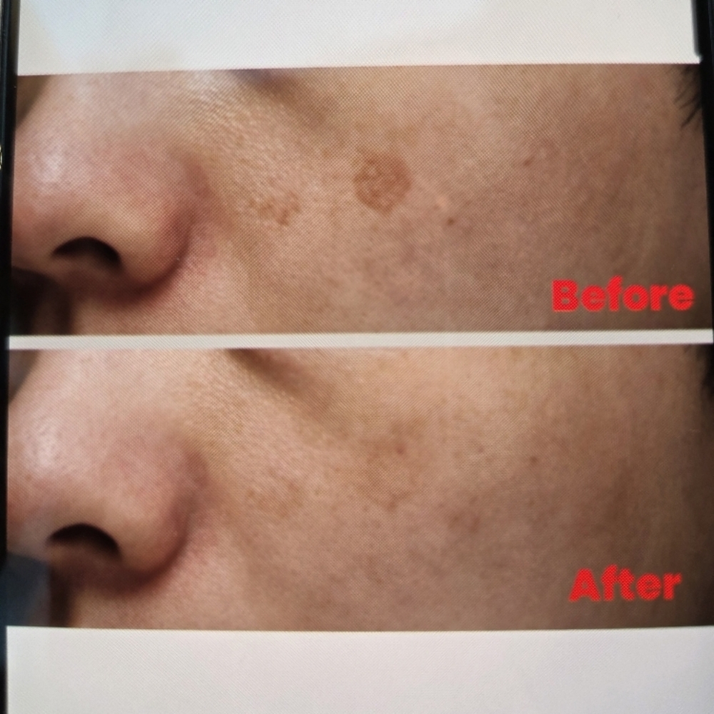 Hyperpigmentation Chemical Peel at Sun Skincare LLC in Scottsdale, AZ
