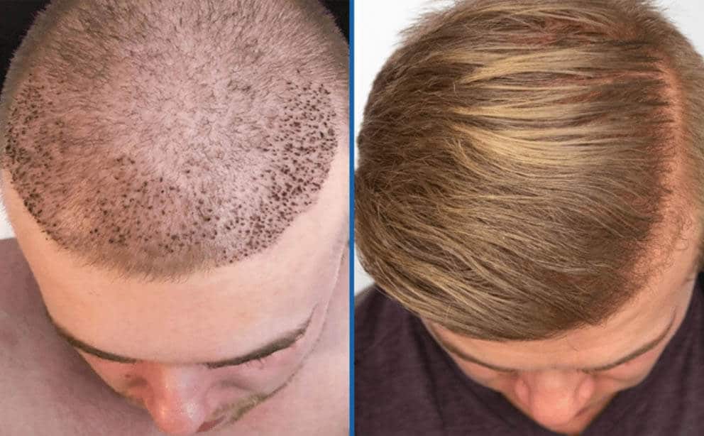 Hair Grafting