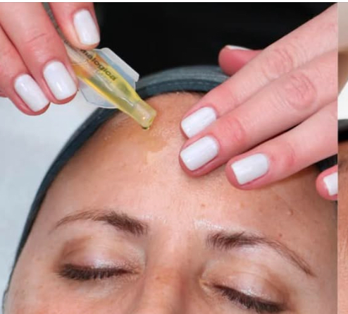 Mild-Chemical Peel