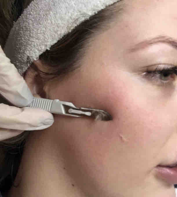 Dermaplanning Facial