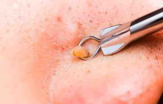 EXTRA EXTRACTIONS