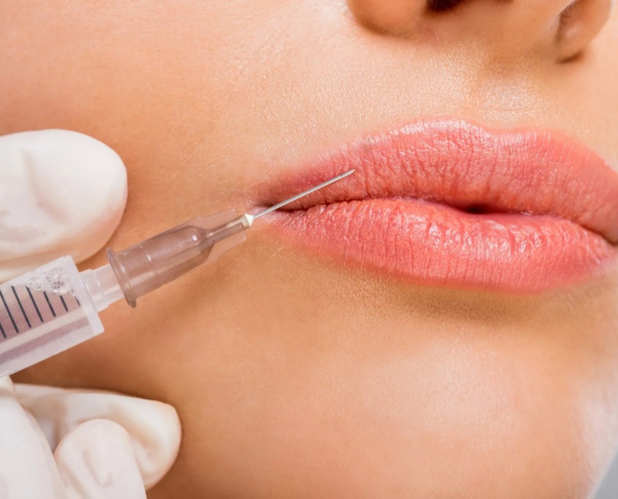 Juvederm XC