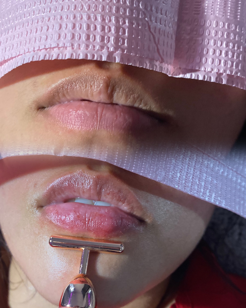 Needle Less Lip Fillers