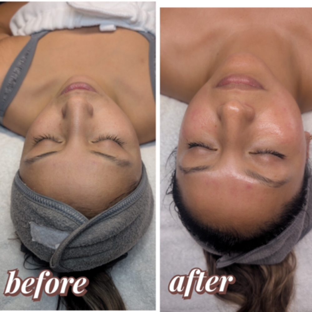 Hydrating Facial w/ Hyaluronic Acid at Nenusk Aesthetics in Long Island City, NY