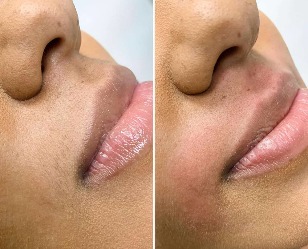 Upper Lip