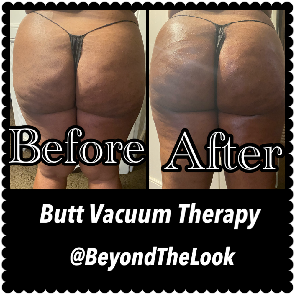 Butt Vacuum Therapy