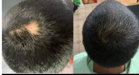 PRP for Hair Restoration And Reguvi