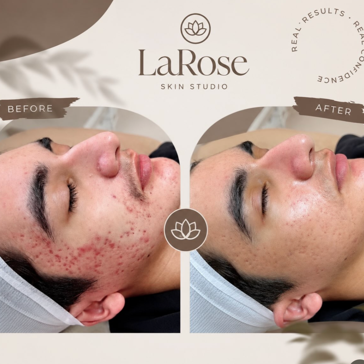 PROCELL Microchanneling at LaRose Skin Studio in Riverside, CA