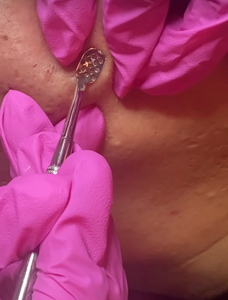 Acne Facial