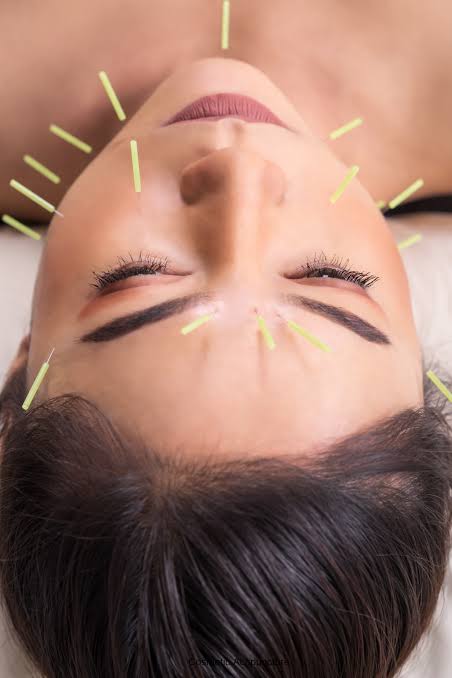 Cosmetic Acupuncture Facial