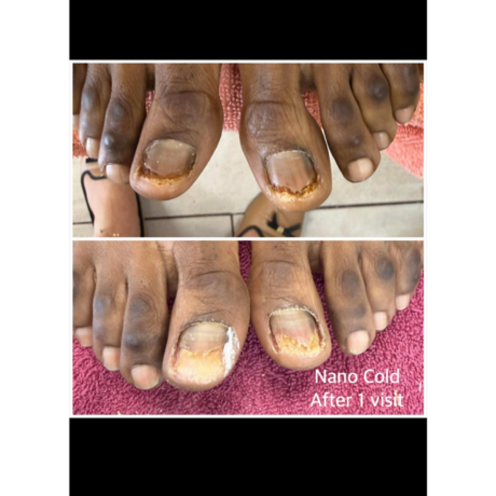 Fungus Care :Small Nails at Excellent Nails By Sandy in California, CA