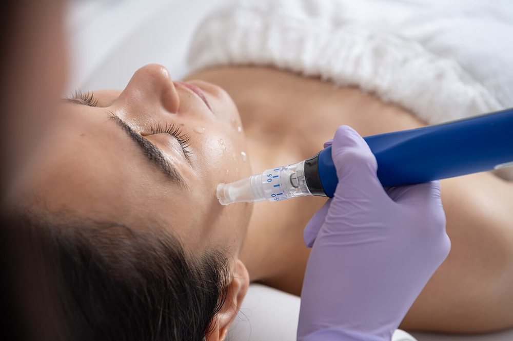 Microneedling at Younger Face and Body in Katy, TX