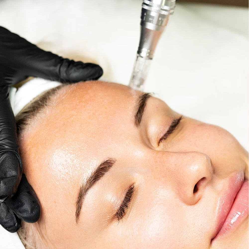Signature Microneedling at Simply Skin Aesthetics in Springfield, MO