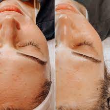 Acne Facial
