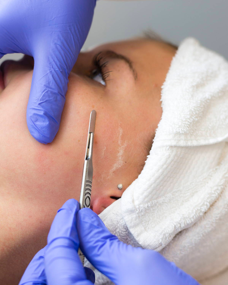 Dethorning (Dermaplaning) Facial