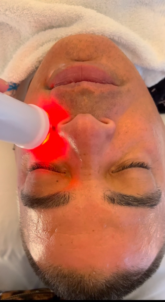Radiofrequency Skin Tightening