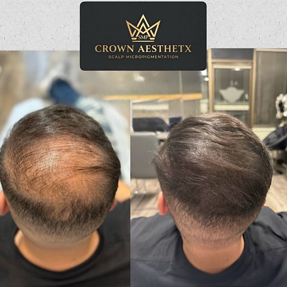 Men’s SMP Density at Crown Aesthetx in Modesto, CA