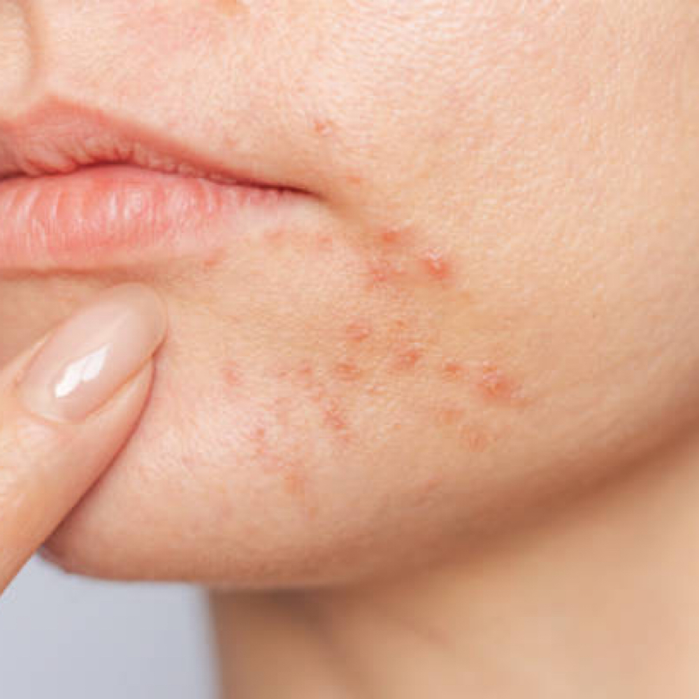 Returning Patient Acne Program at anasko skin studio in Dallas, TX